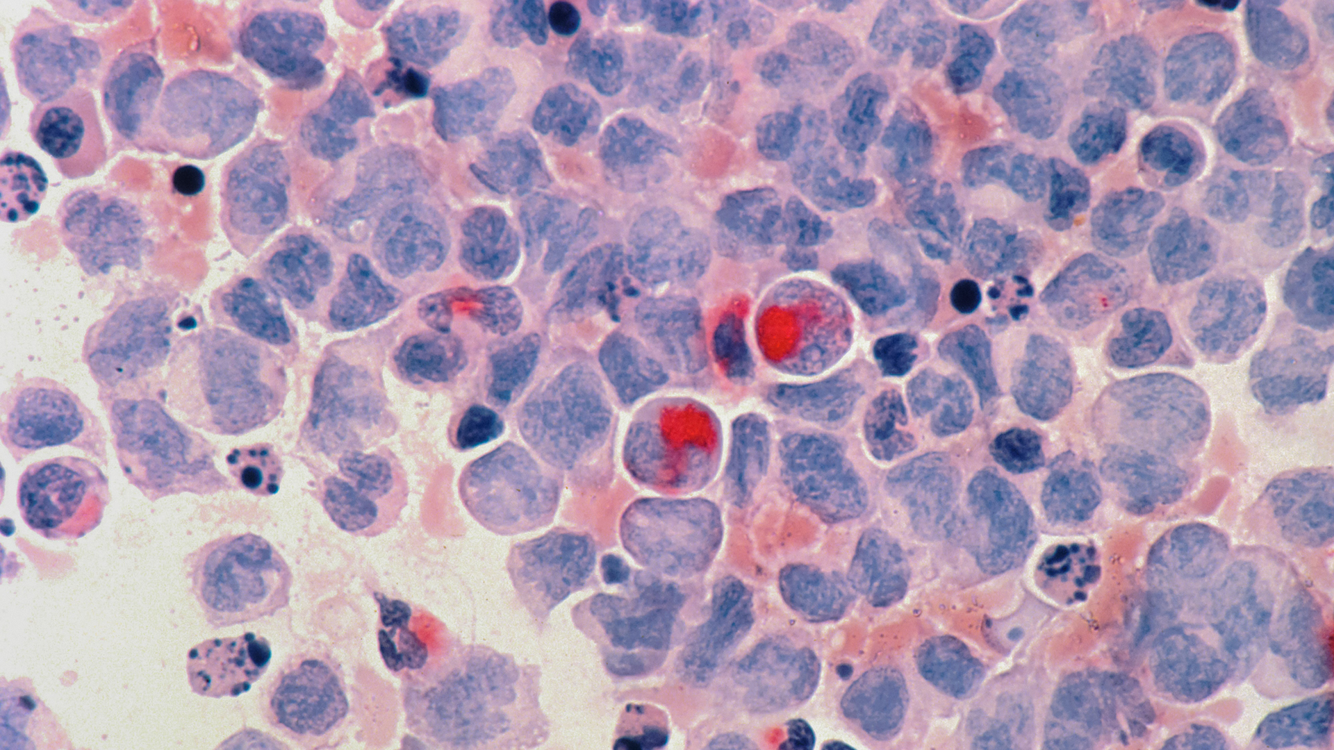 Immagine di cellule tumorali al microscopio
