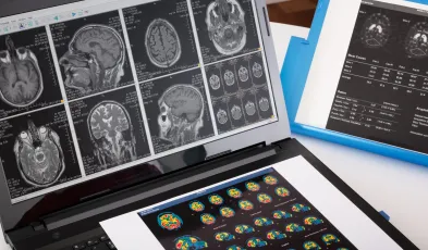 POPS_elettrostimolazione encefalica